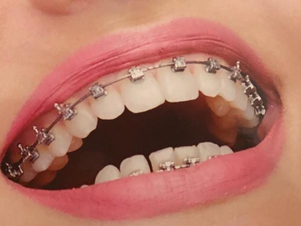 16 Leczenie ortodontyczne dzieci i dorosłych